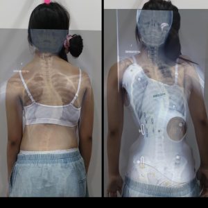 khách hàng sử dụng Áo chỉnh hình cột sống 3D AI