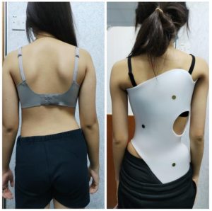 khách hàng sử dụng Áo chỉnh hình cột sống 3D AI