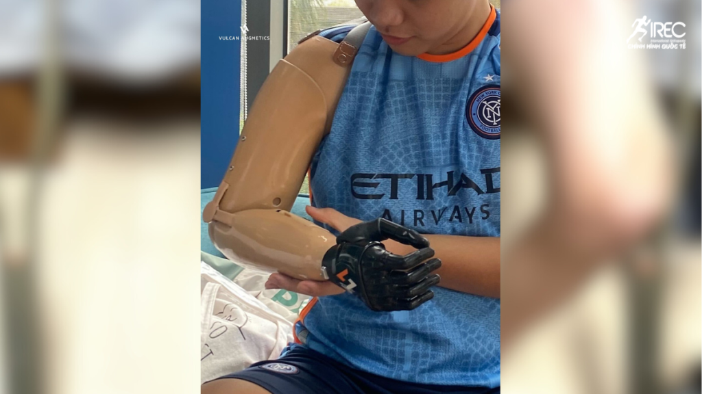 Tay Giả Dưới Khuỷu