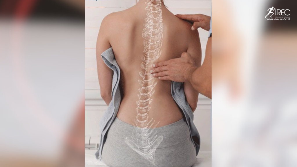 Vẹo Cột Sống

