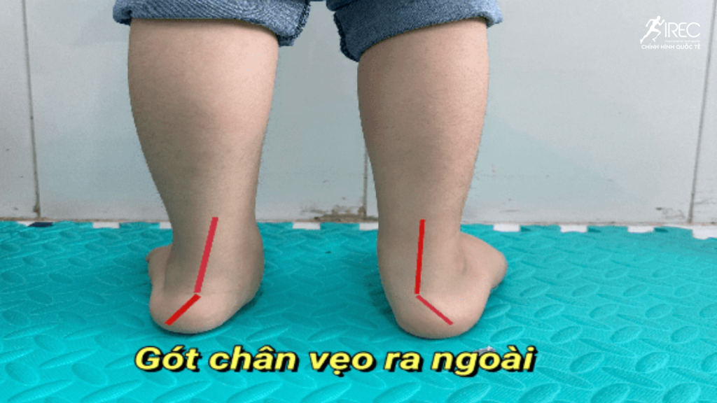 Bàn Chân Bẹt