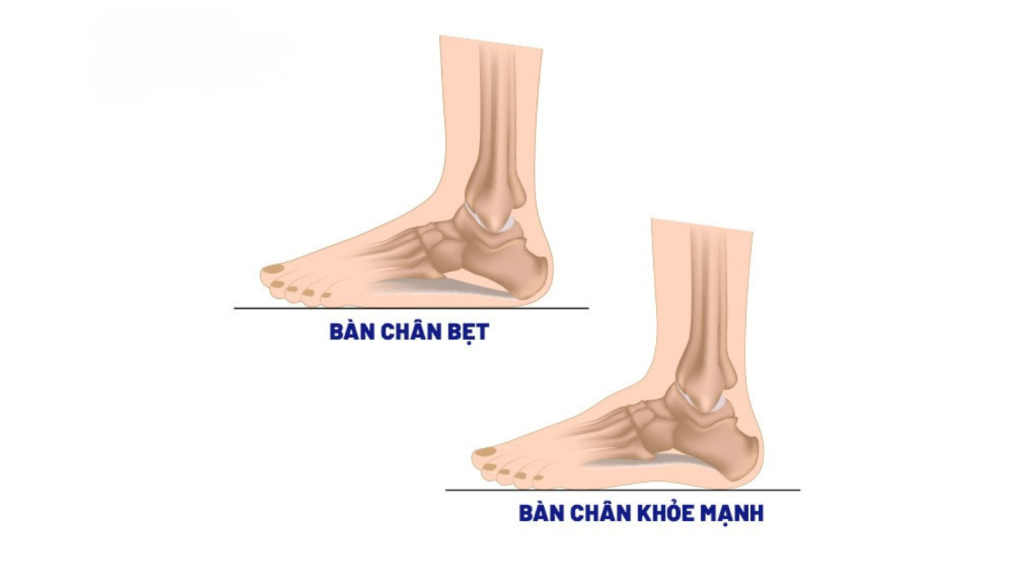 Bàn Chân Bẹt