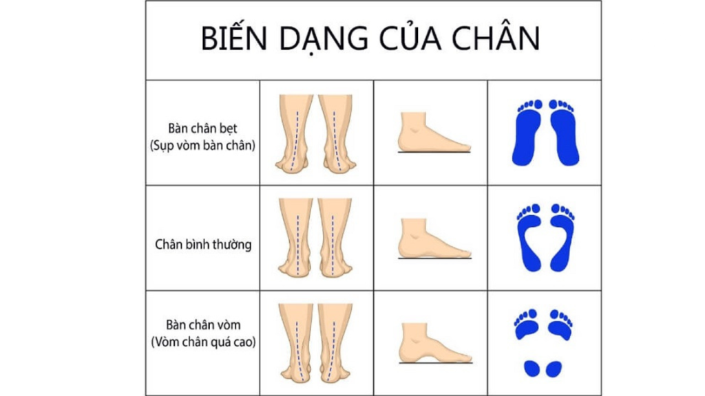 Bàn Chân Bẹt